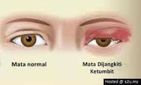 Kamus besar dari ketumbit dalam bahasa indonesia. Punca Dan Gejala Pakar Rawatan Mata I Drop Annusyrah Facebook