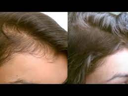 Kera xl growth serum should be ideally used according to prescription of your dermatologist. Hair Growth Serum Must Watch Youtube