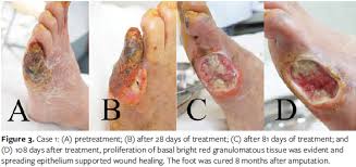 Drink fluids frequently to help the healing process. Lower Limb Nonhealing Ulcers Associated With Chronic Diabetes A Case Series Wounds Research
