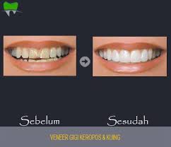 Ada dua jenis veneer, yakni veneer direct dan veneer indirect. Veneer Gigi Kendari Berkualitas Dengan Harga Terjangkau