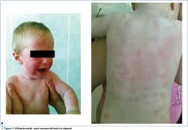 Șoc anafilactic amenințătoare de viață, angioedem. Ghid Practic De Diagnostic Èi Tratament Al Urticariei La Copil