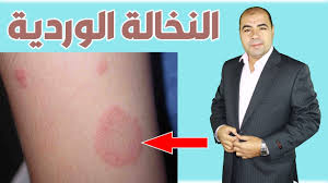 اسباب وعلاج النخالة الوردية وهل تؤثر علي الحمل youtube