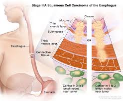 Stage 1 means a small tumor spread to nearby tissue. Department Of Surgery Esophageal Cancer