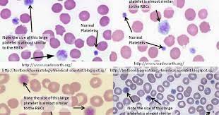Haematology in a NutShell: Large Platelets