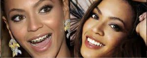 From kylie jenner to zac efron, some of our favourite. Celebrities With Braces From Prince Harry To Beyonce