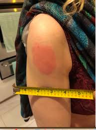 An itchy, red rash pops up on the arm that was injected. What S The New Phenomenon Called Covid Vaccine Arm Psychology Today