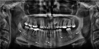 We did not find results for: Florid Cementoosseous Dys Plasia Is Situated At The Right Left And Download Scientific Diagram