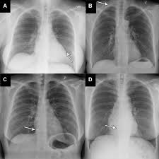 Image result for Chest XRay