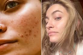 Paris Jackson Shares Unfiltered Before-and-After Acne Photos