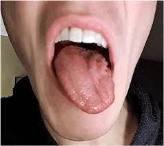 Persistent Isolated Unilateral Hypoglossal Nerve Palsy 4.2 coeliac trunk compression syndrome.