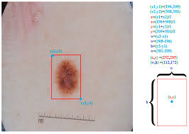 Diagnostics Free Full Text Skin Lesion Segmentation In