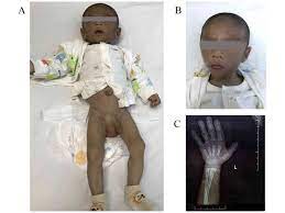 A patient with congenital lipodystrophy or lipoatrophic diabetes. Novel Compound Heterozygous Variant Of Bscl2 Identified By Whole Exome Sequencing And Multiplex Ligation Dependent Probe Amplification In An Infant With Congenital Generalized Lipodystrophy