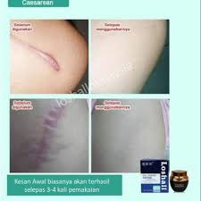 Apakah itu krim untuk menghilangkan jerawat. Krim Hilangkan Parut Shopee Malaysia