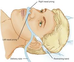 Adult, nasal cannula with curved prongs, ear guards and tube, 5m. Medical Gas Therapy Thoracic Key