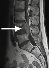 Cauda Equina Compression In Metastatic Prostate Cancer Bmj Case Reports