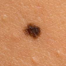 Two new studies find an association between breast cancer and moles. New Studies On Breast Cancer Risk 23andme Blog