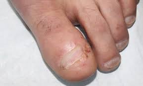 Image result for Onychotillomania feet