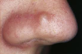 Banish rosacea with #1 most effective cream. Six Common Types Of Bumps On Your Skin And The Ones That Could Be Deadly