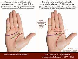 Nov 21, 2019 · stpc or other similar palm crease patterns can help your healthcare provider identify a few disorders, including: Pin On Md Stuff
