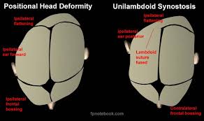 Image result for Positional Head Deformity