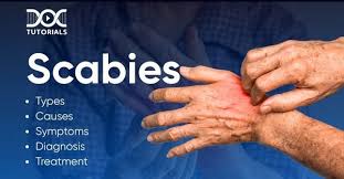 Image result for scabies symptoms