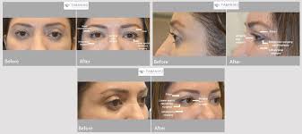 Customized Infraorbital Rim Implant Beverly Hills