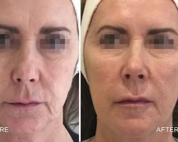 Image of Before and after Profileo treatment