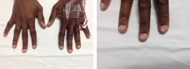 The following list of conditions have 'plummer's nails' or similar listed as a symptom in our database beginning with n. Spooning Of The Nails And Webbing Of The Esophagus Koilonychia And Plummer Vinson Syndrome Mangla 2019 Clinical Case Reports Wiley Online Library