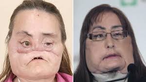 He received a partial face transplant in 2006. Woman Who Received First Us Face Transplant Dies 11 Years On Metro News