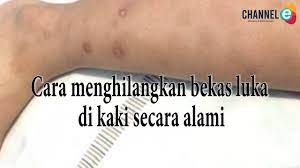 Kompres bekas luka dengan bantalan hangat. Cara Menghilangkan Bekas Luka Di Kaki Secara Alami Youtube