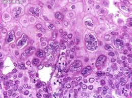 If you have a health. Webpathology Com A Collection Of Surgical Pathology Images