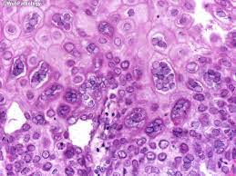 Esophagitis may cause odynophagia and even esophageal hemorrhage, which is usually occult but can be massive. Webpathology Com A Collection Of Surgical Pathology Images