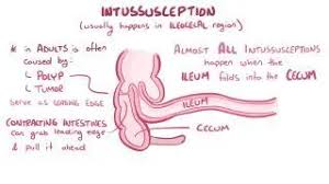 Image result for Intussusception