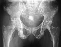 They use small doses of radiation to take pictures of inside your chest. Prostatic Carcinoma With Bony Metastasis Radiology Case Radiopaedia Org