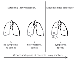Check spelling or type a new query. Lung Cancer Screening Early But Not Early Enough En Testing Treatments Interactive
