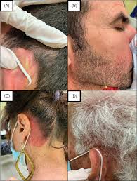 Image result for koebner phenomenon psoriasis