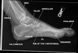Magnetic resonance imaging (mri) is the modality of choice in diagnosing accessory muscles, delineating their relationship to adjacent structures, and . How To Read An Mri Of The Knee Arxiusarquitectura