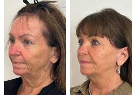 Neck Lift in Albuquerque