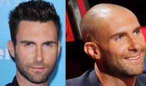Celebrity Hair Transplants Undergoing Cosmetic Procedures As A Public Figure Hair Transplant Women Best Hair Transplant Fue Hair Transplant