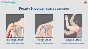 Image result for Frozen Shoulder