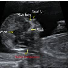 What does nt stand for? Measurement Of Nuchal Translucency Nt And Other Landmarks Download Scientific Diagram