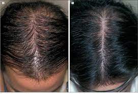 Oral contraceptives (ocp) in combination with spironolactone. Table 1 From Finasteride Treatment Of Female Pattern Hair Loss Semantic Scholar