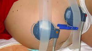 Schwangerschaftswoche wird die geburt eingeleitet. á… Geburt Einleiten Studie Sieht Bei Alteren Frauen Weder Vor Noch Nachteile