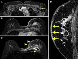 Inflammatory breast cancer (ibc) is one of the most aggressive forms of breast cancer. Figure 1 Mri Findings Of Inflammatory Breast Cancer Locally Advanced Breast Cancer And Acute Mastitis T2 Weighted Images Can Increase The Specificity Of Inflammatory Breast Cancer Springerlink