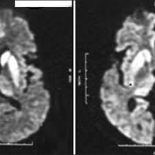 Any great nhl collector wants an authentic autographed hockey stick for their collection. Mri Showing Hockey Stick Sign Download Scientific Diagram