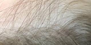 As any blonde will tell you, not all blonde colors are created equal—and more often than not, the difference comes down to the undertone, aka the base shade. What Does Head Lice Look Like Licedoctors