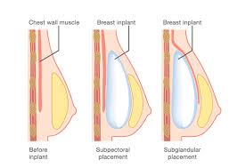Check spelling or type a new query. Placement Of Breast Implants During Breast Augmentation Surgery
