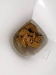 Image result for yellow stool human poop