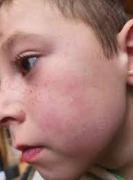 Are there any parents of young children with the condition in the UK?