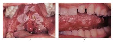 Image result for Secondary Syphilis